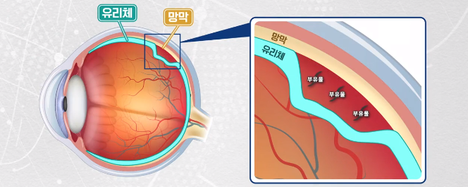 고도근시비문증