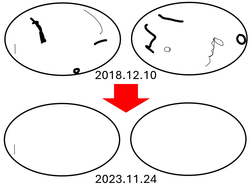 비문증심해짐